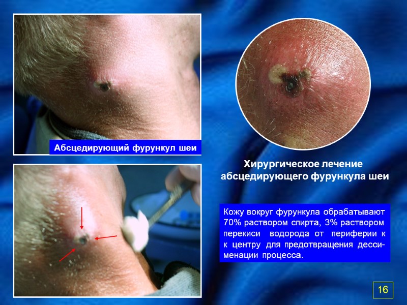 Хирургическое лечение  абсцедирующего фурункула шеи Абсцедирующий фурункул шеи Кожу вокруг фурункула обрабатывают 70%